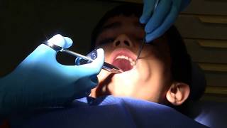 Tooth filling in school dental clinic Part 2 Tooth filling [upl. by Eniarrol]