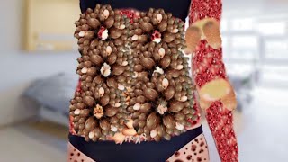 ASMR Treatment Animation Remove Maggot Girl Belly  Pimple Popping ASMR  2D Animation PaponASMR [upl. by Hilten]