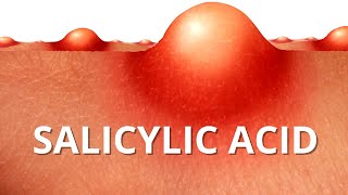 Heres WHY Salicylic Acid is Best For ACNE [upl. by Netloc]