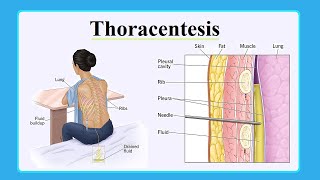 thoracentesis [upl. by Mclaurin]