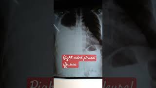 Pleural effusion  right [upl. by Jariah883]