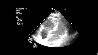 Pulmonary Embolus McConnells Sign [upl. by Guyer19]