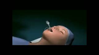 how to perform Tracheostomy tube ETT [upl. by Jeri]