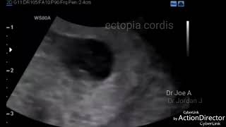 Ectopia cordis ultrasound video 8 weeks fetus [upl. by Botsford]