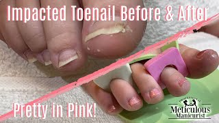 Calloused Heels amp Impacted Toenail How To Cleaning Transformation [upl. by Petronille]