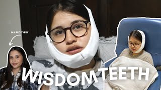 vlog all four wisdom teeth removal in one day my experience and recovery [upl. by Sholeen337]