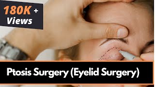 Ptosis Surgery Eyelid Surgery in Mumbai India by Best Oculoplastic Surgeon  Dr Debraj Shome [upl. by Adnirak96]