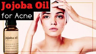 Jojoba Oil for Acne Does It Work And How To Use It [upl. by Charis]