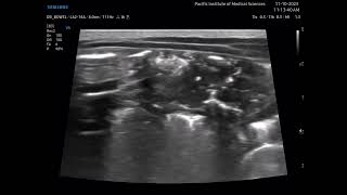 Necrotizing enterocolitis NEC [upl. by Suoirad]