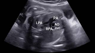 FETAL ECHO  NORMAL BASIC AND EXTENDED VIEWS IN GREYSCALE [upl. by Ahcarb]