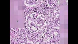 Histopathology LungAdenocarcinoma [upl. by Inaffets803]