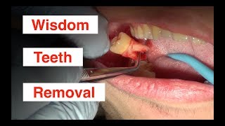 GETTING MY WISDOM TEETH REMOVED [upl. by Valoniah]