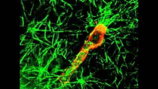 Fibroblast moving through collagen net thereby causing fascial contracture [upl. by Currey]