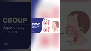 Barking cough in Croup [upl. by Lemar]