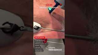 VBeam PulsedDye Laser Treatment [upl. by Lerrad552]