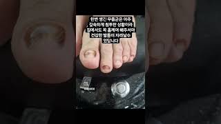 발톱안에 곰팡이가 foodshorts foot 광주발톱무좀 [upl. by Mallin]