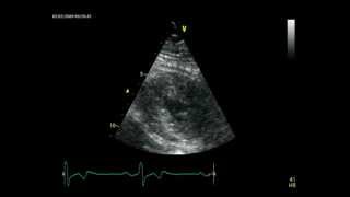 APICAL HYPERTROPHIC CARDIOMYOPATHY  ECHOCARDIOGRAPHY cardiac ultrasound [upl. by Lednew742]