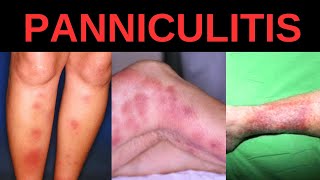 WHAT IS PANNICULITIS SYMPTOMS CAUSES TREATMENT [upl. by Dorman]