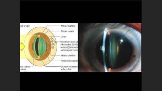 cataract and ectopia lentis [upl. by Netnilc449]