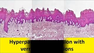 A Case of Proliferative Verrucous Leukoplakia [upl. by Travers]