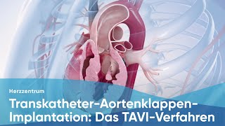 TranskatheterAortenklappenImplantation Das TAVIVerfahren [upl. by Sandler]