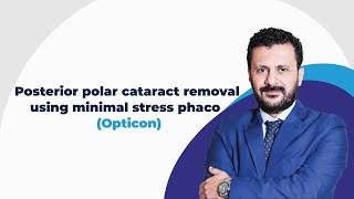 Posterior polar cataract removal using minimal stress phaco Opticon [upl. by Ybbed]