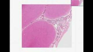 Histopathology Brain Acute pyogenic bacterial meningitis [upl. by Anaehs213]