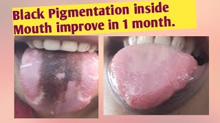 Geographic Tongue with pigmentation cure in 1 monthHow to cure pigmentation of tongue amp Candidiasis [upl. by Ericha62]