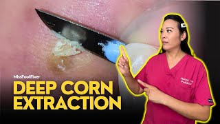 Deep Foot Corn Extraction Satisfying Removal Technique  FootClinicLondoncouk [upl. by Wainwright]