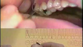 Periodontal Charting Procedure [upl. by Zoi219]