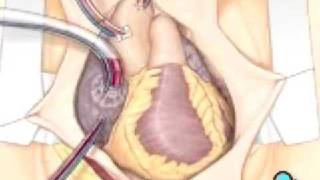 Malpractice Medical Coronary Artery Bypass Graft CABG Surgery 3 [upl. by Ahsinauq526]