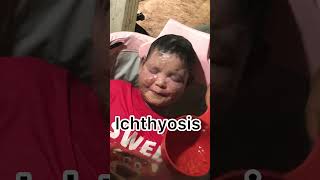 Ichthyosis skincare Ichthyosis eczema [upl. by Ailene]