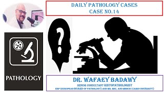 DAILY PATHOLOGY CASES CASE NO 14 BY DR WAFAEY BADAWY [upl. by Mayce]