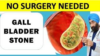 No Pain No Surgery Needed  Asymptomatic Gall Bladder Stone Treatment  DrEducation [upl. by Llerrot570]