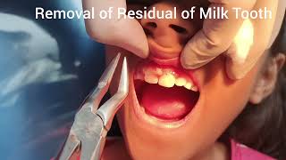 Painless removal of Residual of Milk Tooth ll Removal under surface gel only [upl. by Seel]