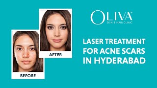 Laser Treatment For Acne Scars In Hyderabad – Dermatologists For Pimple Marks [upl. by Emma]