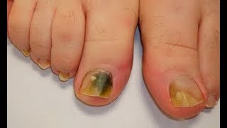 Ce remède de 3 Ingrédients élimine la mycose des ongles définitivementsanté c0ns3ils [upl. by Idner495]