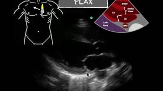 POCUS PLAX Severely Reduced EF [upl. by Melloney]