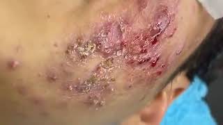 Acne blackheads Big Cystic Acne Blackheads Extraction Whiteheads Removal Pimple Popping [upl. by Nauqad]