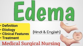 Edema  Edema In Hindi  Oedema [upl. by Kessler]