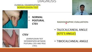 Congenital Talipes Equino Varus CTEV  Rapid Revision of Orthopaedics by Dr Prateek Joshi [upl. by Marylinda307]