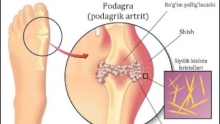 Podagra kasalligi haqida Подагра касаллиги [upl. by Haliled]