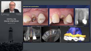 Case examples using full digital workflow [upl. by Olcott324]