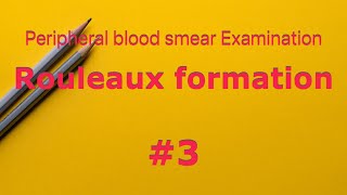 Rouleaux formation  peripheral blood smear Examination  Hematology  Multiple Myeloma ESR [upl. by Erdnua]