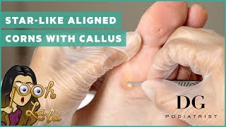 Starlike aligned corns with callus [upl. by Enelyk]