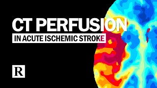 CT Perfusion In Acute Ischemic Stroke [upl. by Rtoip]