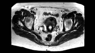 Tamoxifen associated endometrial hyperplasia [upl. by Tehr]