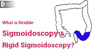 Rigid vs Flexible Sigmoidoscopy  Dr Rajasekhar M R [upl. by Yelserp]