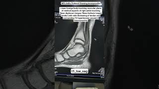 MRI Ankle Showing tenosynovitis in t1tsesag Sequence beginners [upl. by Andromada]