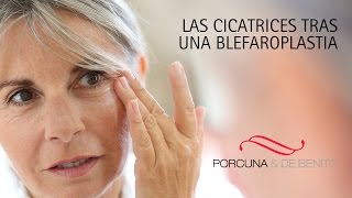 Las cicatrices tras una blefaroplastia [upl. by Blackmun]